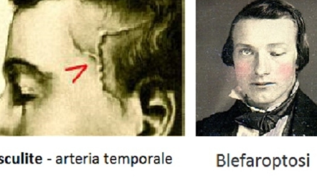 Non &egrave; semplice diagnosticare l&rsquo;arterite a cellule giganti, comunque dei sintomi sono caratteristici.