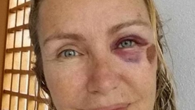 Licia Col&ograve;, l'occhio nero: "Sono scivolata sullo skateboard di mia figlia"