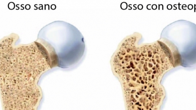 L'osteoporosi , una grave malattia dell'osso.