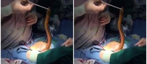 Homem passar por cirurgia para retirada de peixe