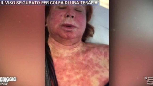 Il volto di Marina Ripa di Meana sfigurato (immagine Pomeriggio 5)