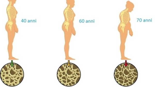 Un nuovo farmaco (abaloparatide) &egrave; stato approvato negli Stati Uniti. &Egrave; indicato nei casi pi&ugrave; gravi di osteoporosi.