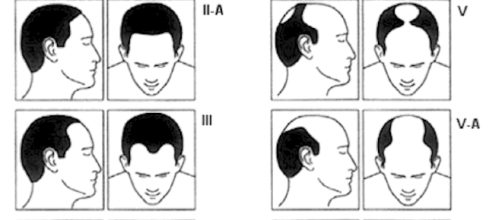 Tabela Norwood mostra o padr&atilde;o da calv&iacute;cie masculina