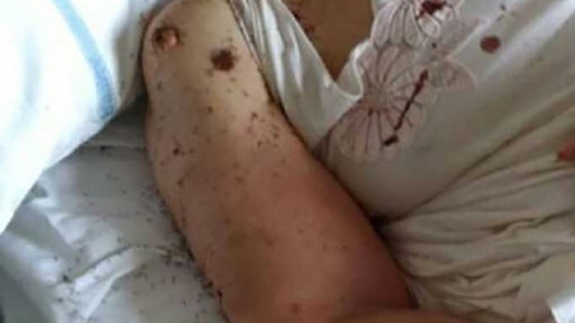Choc a Napoli, donna abbandonata in letto d'ospedale tra le formiche - foto: grandenapoli.it