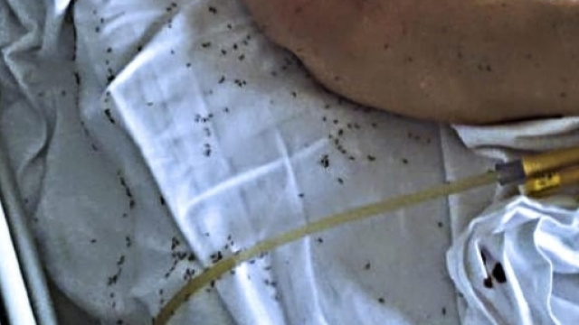 Napoli: paziente di un ospedale circondata dalle formiche.