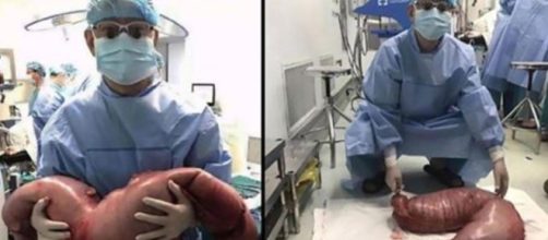 A cirurgia demorou cerca de 3 horas para conseguir remover o intestino ( Foto: Reprodu&ccedil;&atilde;o)