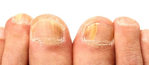 Natural Home Remedies for Removing Yellow Nails - Go Fit ... - gofitstayfit.com