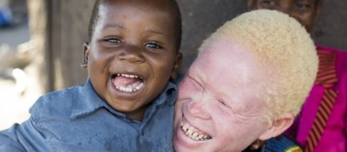 Hoy es el D&iacute;a Internacional de Sensibilizaci&oacute;n sobre el Albinismo