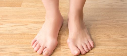 How To Treat Bunions Naturally Without Surgery - Guillaume Paumier via wikimedia