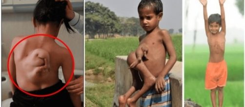 Pessoas que nasceram com partes extras no corpo