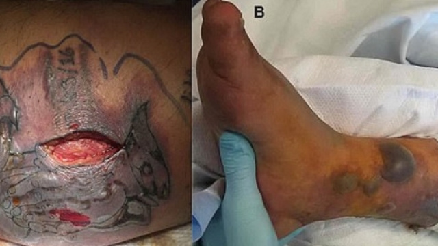 Tatuaggio, fa bagno subito dopo e si infetta: ucciso da batterio ... - blitzquotidiano.it
