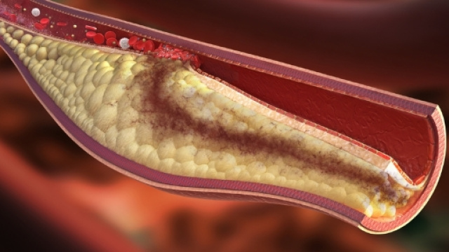 Creato il vaccino anti colesterolo