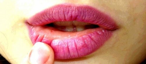 El herpes est&aacute; causado por un virus, por lo que los antibi&oacute;ticos no tienen ning&uacute;n efecto sobre &eacute;l