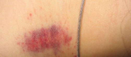 No passado, garoto mexicano morre aos 17 anos ap&oacute;s receber &ldquo;chup&atilde;o&rdquo; no pesco&ccedil;o. ( Foto Reprodu&ccedil;&atilde;o).