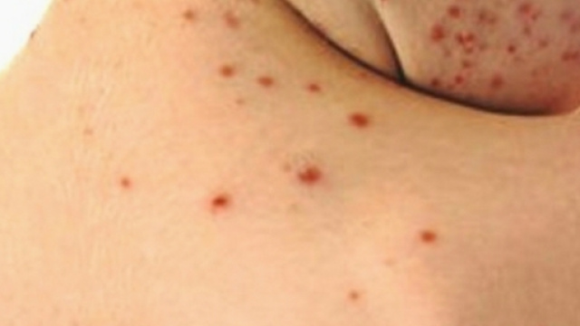 Morbillo: muore a Roma bambina di 9 anni - wired.it