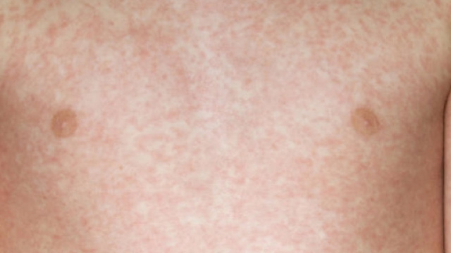 Roma, bambina morta per morbillo. Non era vaccinata