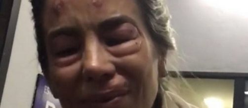 Dani Winits mostra rosto deformado. Entenda o que houve