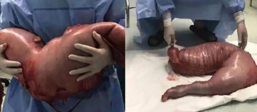 "Pensei que poderia explodir a qualquer momento", disse o m&eacute;dico que operou o chin&ecirc;s; rapaz foi diagnosticado com Doen&ccedil;a de Hirschsprung