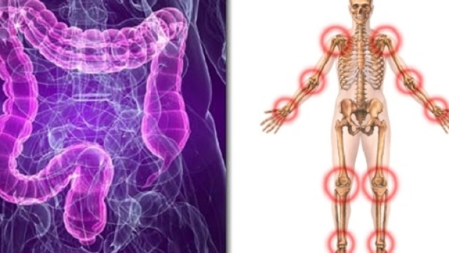 Identificate due proteine autoantigene (GNS e FLNA), prodotte da comuni batteri intestinali, presenti anche nel liquido sinoviale.