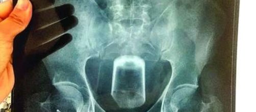 Copo de vidro quebra dentro do corpo e italiano precisa de cirurgia para retir&aacute;-lo (Foto: Reprodu&ccedil;&atilde;o)