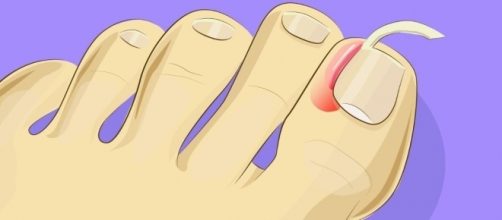 Veja como tratar unha encravada em casa.