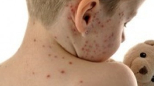 Casi di morbillo pi&ugrave; che raddoppiati in un solo mese