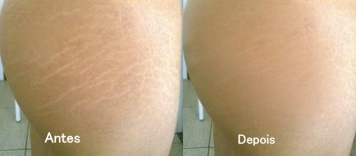 Confira t&eacute;cnicas para acabar com as estrias em casa