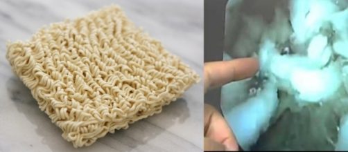 Veja o que acontece no seu est&ocirc;mago ap&oacute;s voc&ecirc; comer miojo ( Foto: Reprodu&ccedil;&atilde;o)