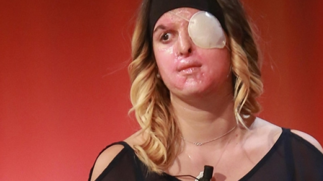 Gessica Notaro, la ragazza sfregiata con l'acido dall'ex fidanzato, rischia di perdere la vista all'occhio sinistro