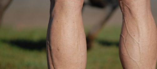 How To Get Rid Of Spider Veins Naturally? - stylecraze.com