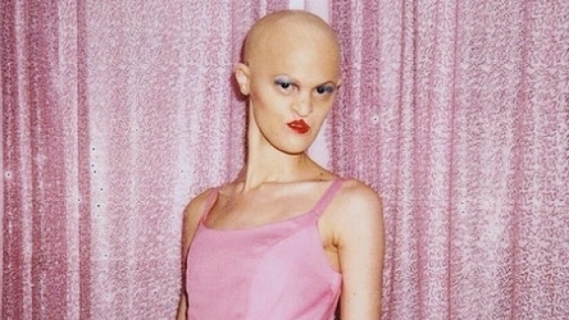 Melanie Gaydos, modella con displasia ectodermica, ritratta da Alexander Federic