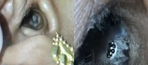 Uma aranha &eacute; encontrada ainda viva no ouvido de uma mulher na &Iacute;ndia