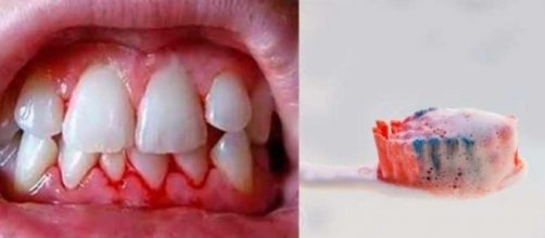 Sua gengiva sangra durante a escova&ccedil;&atilde;o? Seu cora&ccedil;&atilde;o pode estar em risco!