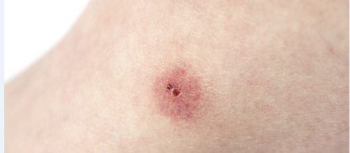 La enfermedad de Chagas - com.ni