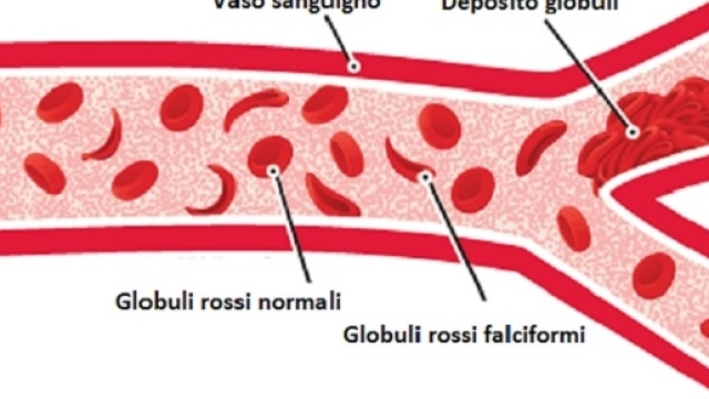 L&rsquo;anemia falciforme &egrave; ancora oggi una malattia incurabile. Di recente &egrave; stato segnalato il primo caso di guarigione con una terapia sperimentale