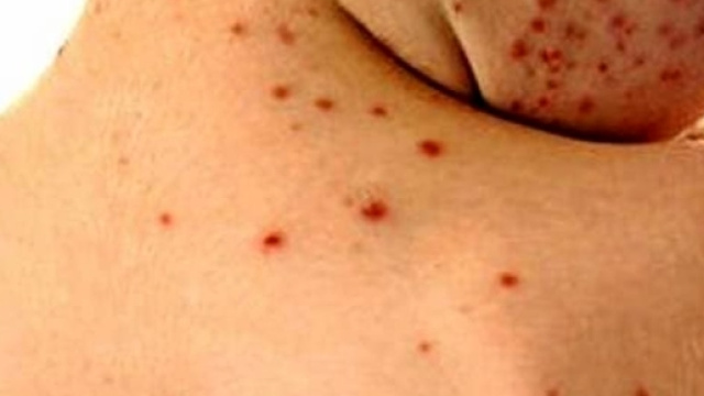 Morbillo: bimba di 16 mesi &egrave; morta a Roma - trentotoday.it