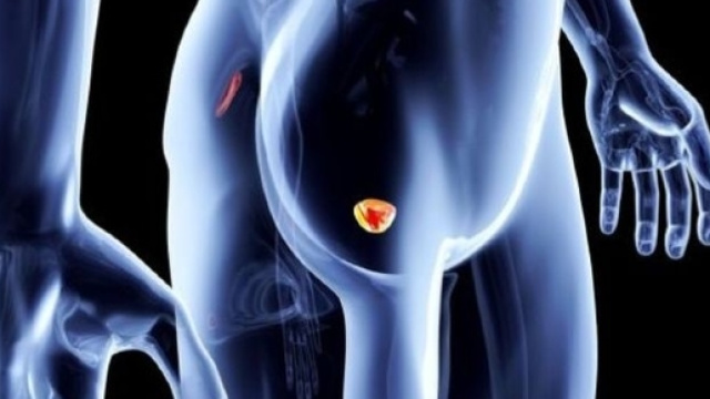 Caff&eacute; e tumore alla prostata: il legame &egrave; racchiuso in 3 tazzine ... - velvetbody.it