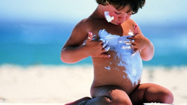Crema solare inefficace: bimbo con gravi ustioni sulla schiena in Galles