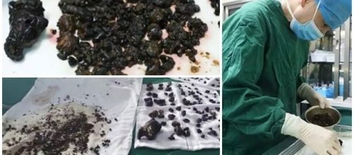 Mulher passar por cirurgia para remo&ccedil;&atilde;o de pedras