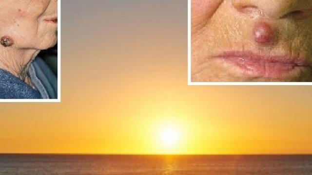 Entro fine anno il primo farmaco per il trattamento del carcinoma metastatico a cellule di Merkel.