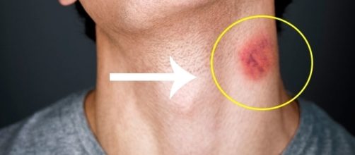 Um simples chup&atilde;o no pesco&ccedil;o pode ser perigoso ( Foto - Reprodu&ccedil;&atilde;o )