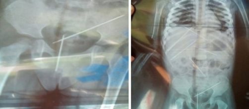 Crian&ccedil;a morre ap&oacute;s ter agulhas inseridas no corpo