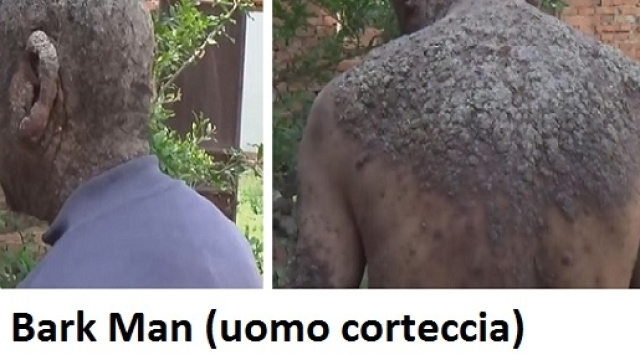 Li Xitian, un uomo di 58 anni che vive in un villaggio cinese, affetto da una grave forma di psoriasi.