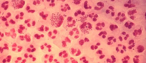histopathology in an acute case of gonococcal urethritis using Gram-stain technique by author CDC/Joe Millar via Wikimedia Commons