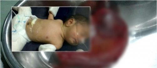Beb&ecirc; &eacute; operado para tirar irm&atilde;o parasita