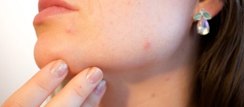 Free photo: Acne, Pores, Skin, Pimple, Female - Free Image on ... - pixabay.com