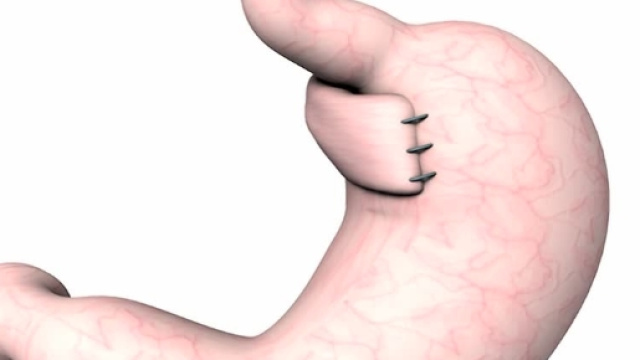 Esofago artificiale: trapianto storico.