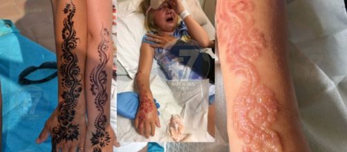 Caso da menina que teve bra&ccedil;o destru&iacute;do por causa de tatuagem de henna ganha destaque nacional