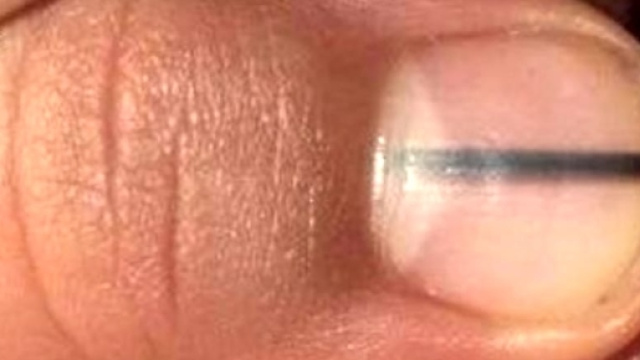 nera sotto l'unghia | salvata dalla sua estetista | E' un melanoma - zazoom.it