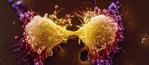 Tumor t&iacute;pico del c&aacute;ncer de pr&oacute;stata. Fotograf&iacute;a del Wall Street Journal